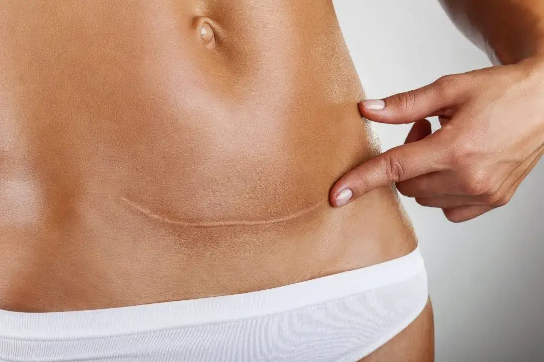 Tratamento a Laser para Cicatriz Preço 