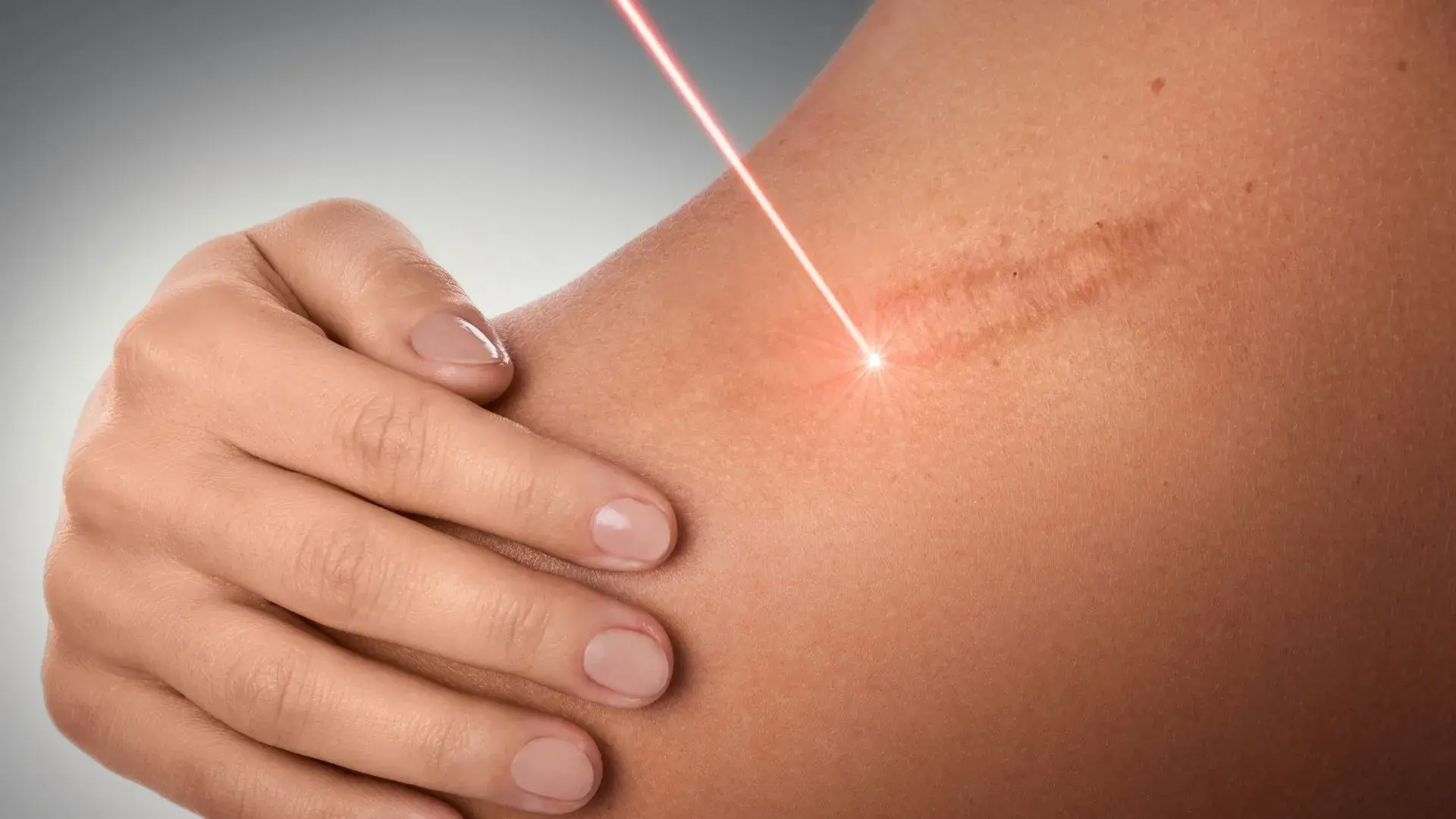 Tratamento com Laser em Guarulhos 